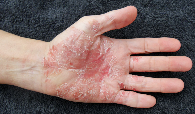 Psoriasis