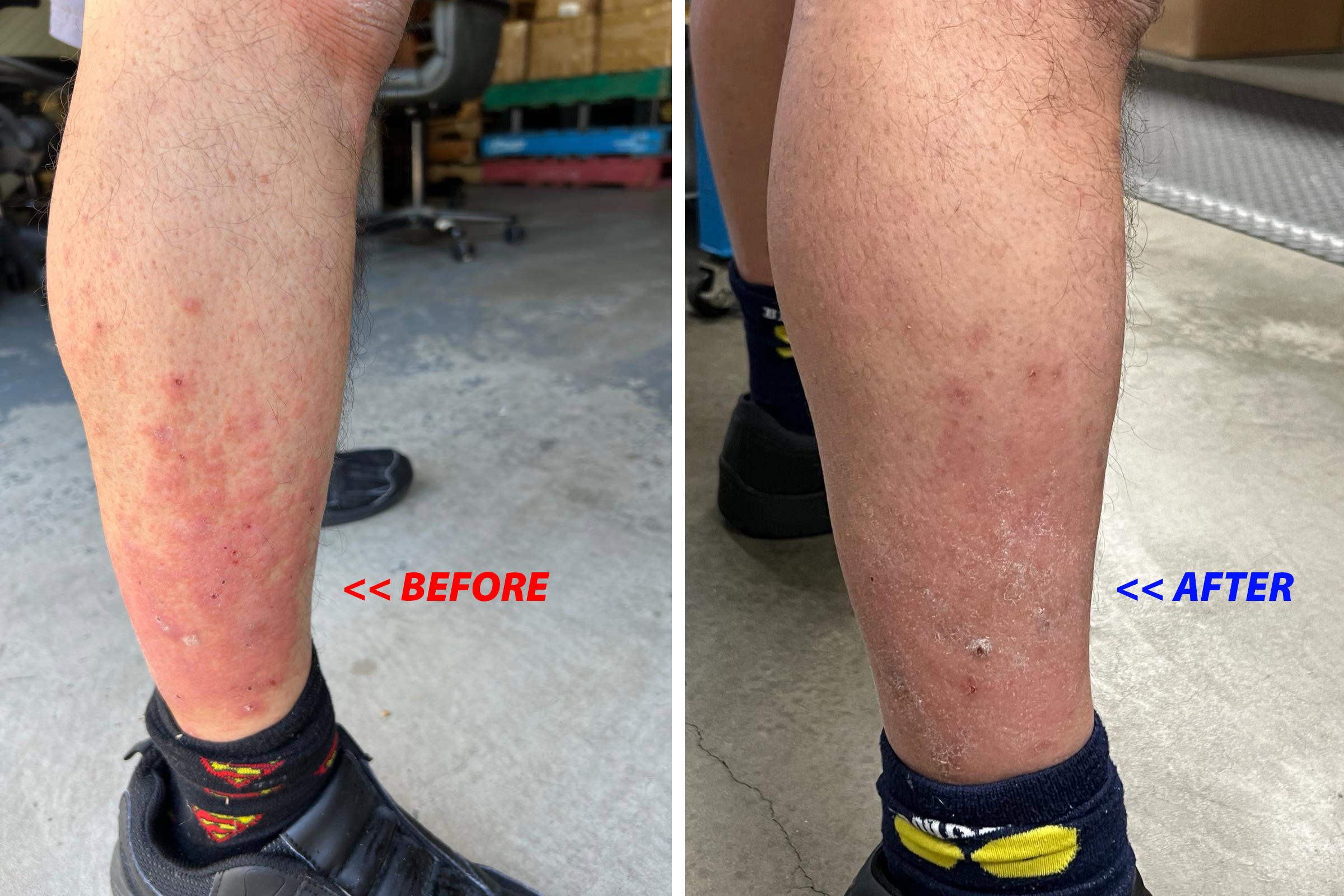 justin-leg-before-after